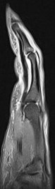 Figure 1 for case Ulnar aspect A3 pulley tear with bowstringing of the flexor tendons